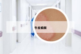 牛皮癣颜