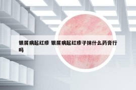 银屑病起红疹 银屑病起红疹子抹什么药膏行吗