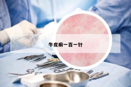 牛皮癣一百一针