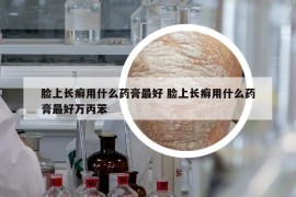 脸上长癣用什么药膏最好 脸上长癣用什么药膏最好万丙苯