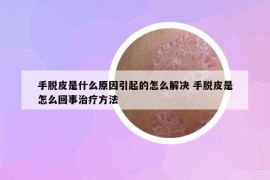 手脱皮是什么原因引起的怎么解决 手脱皮是怎么回事治疗方法