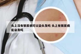 头上没有银屑病可以染头发吗 头上有银屑病能染发吗