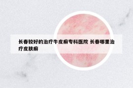 长春较好的治疗牛皮癣专科医院 长春哪里治疗皮肤癣