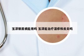 玉泽银屑病能用吗 玉泽能治疗湿疹和皮炎吗