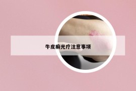 牛皮癣光疗注意事项
