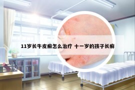 11岁长牛皮癣怎么治疗 十一岁的孩子长癣