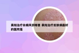 襄阳治疗白癜风到哪里 襄阳治疗皮肤病最好的医院是