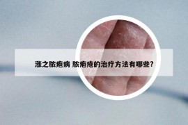 涨之脓疱病 脓疱疮的治疗方法有哪些?