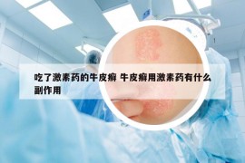 吃了激素药的牛皮癣 牛皮癣用激素药有什么副作用
