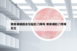 银屑病病因会引起肛门痒吗 银屑病肛门奇痒无比