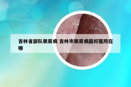 吉林省部队银屑病 吉林市银屑病最好医院在哪