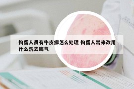 拘留人员有牛皮癣怎么处理 拘留人出来改用什么洗去晦气