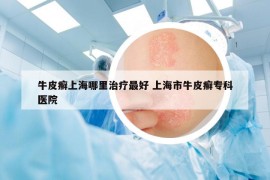 牛皮癣上海哪里治疗最好 上海市牛皮癣专科医院