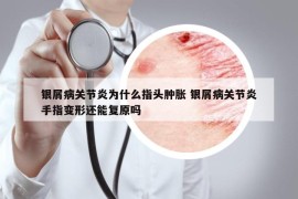 银屑病关节炎为什么指头肿胀 银屑病关节炎手指变形还能复原吗