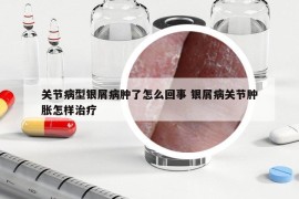 关节病型银屑病肿了怎么回事 银屑病关节肿胀怎样治疗