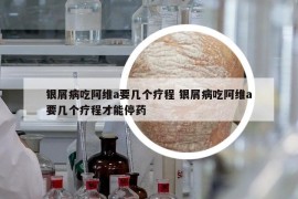 银屑病吃阿维a要几个疗程 银屑病吃阿维a要几个疗程才能停药