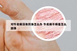 对牛皮癣没有抗体怎么办 牛皮癣不痒是怎么回事