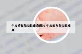 牛皮癣和脂溢性皮炎图片 牛皮廨与脂溢性皮炎