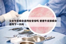 父亲牛皮癣会遗传给宝宝吗 爸爸牛皮肤癣会遗传下一代吗