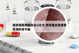 西安银屑病医院必zi北方 西安最厉害看银屑病的老中医