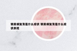 银屑病复发是什么症状 银屑病复发是什么症状表现