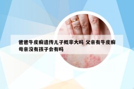 爸爸牛皮癣遗传儿子概率大吗 父亲有牛皮癣母亲没有孩子会有吗