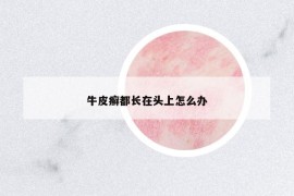 牛皮癣都长在头上怎么办