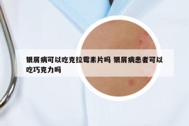 银屑病可以吃克拉霉素片吗 银屑病患者可以吃巧克力吗
