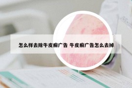 怎么样去除牛皮癣广告 牛皮癣广告怎么去掉
