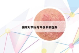 南京好的治疗牛皮癣的医院