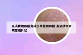 点滴状银屑病变成斑块性银屑病 点滴状银屑病变成片状
