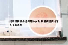姥爷银屑病会遗传外孙女么 银屑病遗传给了儿子怎么办