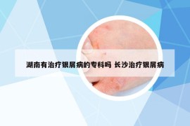 湖南有治疗银屑病的专科吗 长沙治疗银屑病
