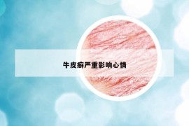 牛皮癣严重影响心情