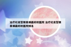 冶疗红皮型银屑病最好的医院 冶疗红皮型银屑病最好的医院排名