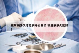 银屑病多久才能到停止生长 银屑病多久能好?