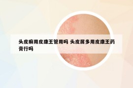 头皮癣用皮康王管用吗 头皮屑多用皮康王药膏行吗