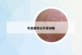 牛皮癣可以不军训嘛