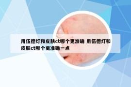 用伍德灯和皮肤ct哪个更准确 用伍德灯和皮肤ct哪个更准确一点