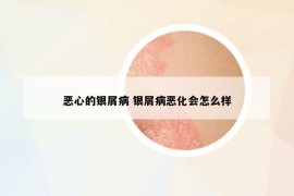 恶心的银屑病 银屑病恶化会怎么样