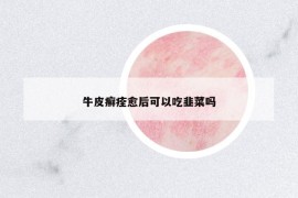 牛皮癣痊愈后可以吃韭菜吗