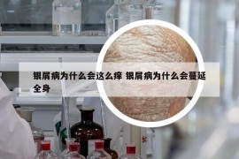 银屑病为什么会这么痒 银屑病为什么会蔓延全身