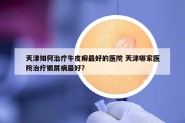 天津如何治疗牛皮癣最好的医院 天津哪家医院治疗银屑病最好?