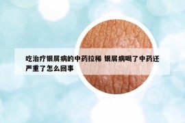 吃治疗银屑病的中药拉稀 银屑病喝了中药还严重了怎么回事