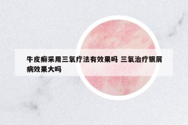 牛皮癣采用三氧疗法有效果吗 三氧治疗银屑病效果大吗