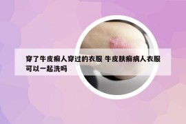 穿了牛皮癣人穿过的衣服 牛皮肤癣病人衣服可以一起洗吗