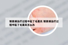 银屑病治疗过程中起了毛囊炎 银屑病治疗过程中起了毛囊炎怎么办
