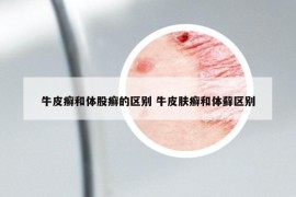 牛皮癣和体股癣的区别 牛皮肤癣和体藓区别