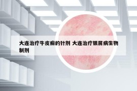 大连治疗牛皮癣的针剂 大连治疗银屑病生物制剂