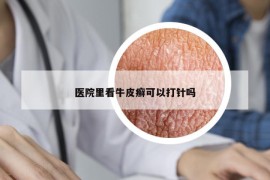 医院里看牛皮癣可以打针吗